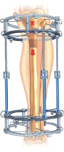 Ring Fixation System